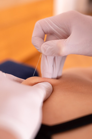 Dry Needling in der Praxis für Osteopathie Leipzig